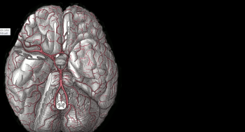 Stroke | Khan Academy