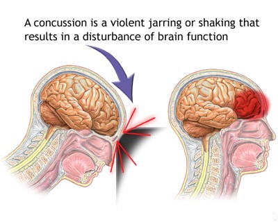 Concussions